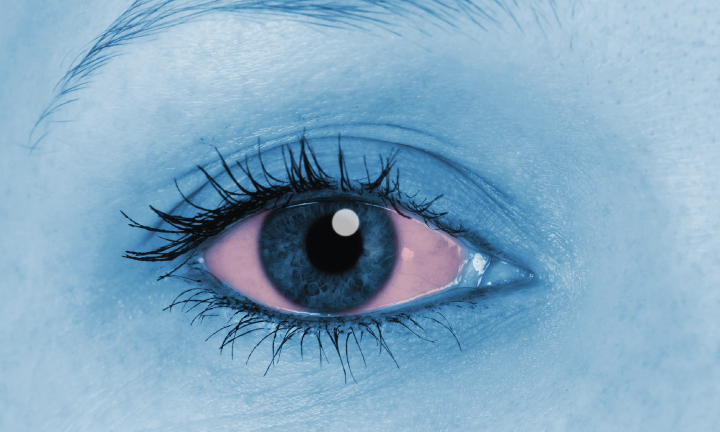 10-most-common-causes-red-eye-and-how-treat-them