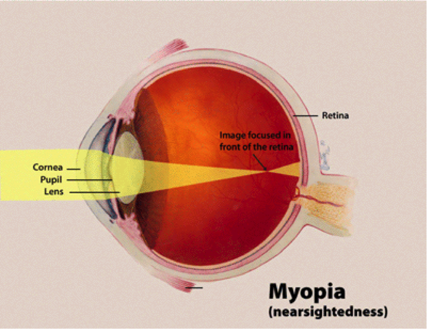 What is Nearsightedness and Farsightedness?