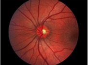 Test Your Macular Degeneration Risk